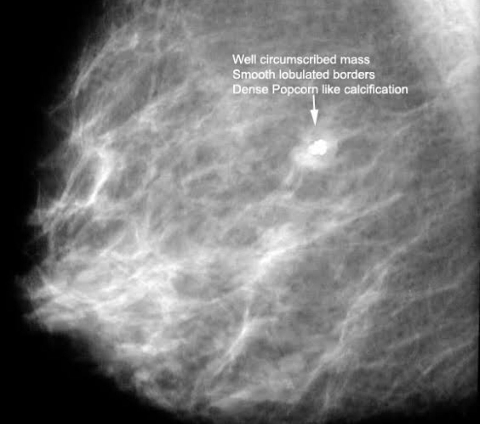 фиброаденома молочной железы маммография фото